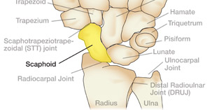 Scapholunate Torn Ligament | The Hand Society