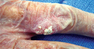 Skin Cancer of the Hand & Upper Extremity | The Hand Society